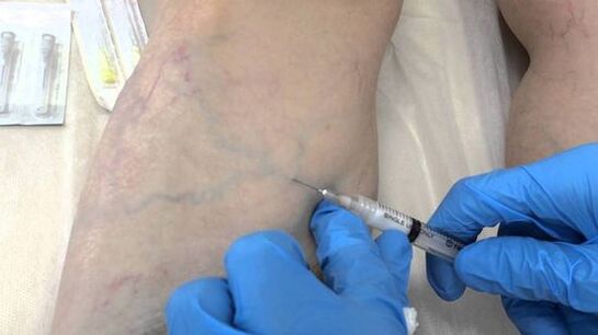 skleroterapia żylaków nóg u kobiet