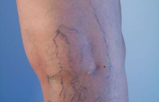 żylaki na nogach u kobiet