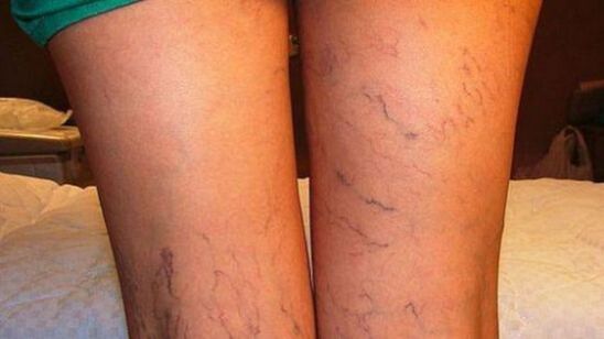 żyły na nogach z żylakami