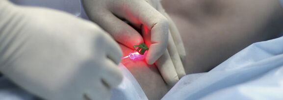 Usunięcie żyły w nodze za pomocą koagulacji laserowej